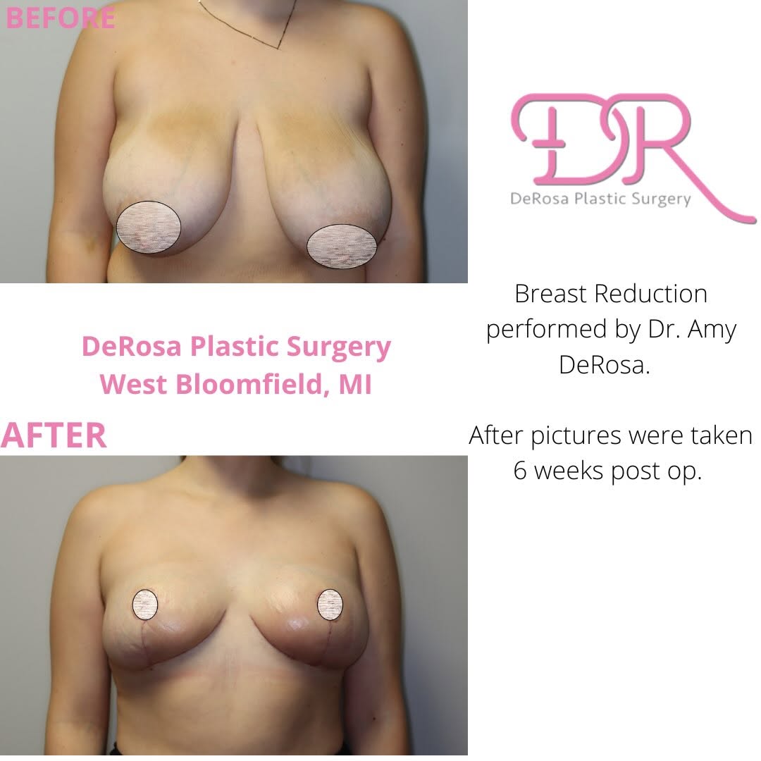 Instagram post by Dr. Amy DeRosa, DO: Breast Reduction performed by Dr. Amy DeRosa. After pictures taken 6 weeks post op. #breastreduction #breastlift #plasticsurgery #beforeanda…