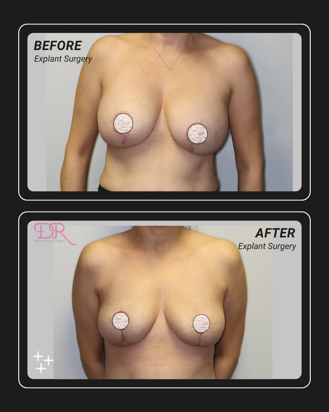 Instagram post by Dr. Amy DeRosa, DO: #beforeandafter #explant with areola adjustments performed by Dr. Amy DeRosa. After pictures were taken 6 weeks post op #breastimplantremova…