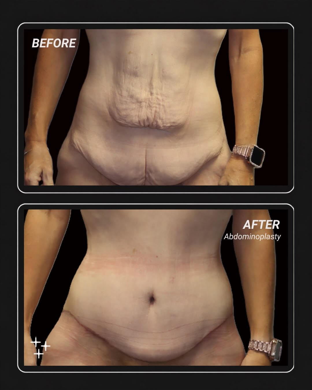 Instagram post by Dr. Amy DeRosa, DO: Before/After Abdominoplasty - after picture were taken 6 weeks post op #beforeandafter #plasticsurgery #mommymakeover #plasticsurgeon #tummy…