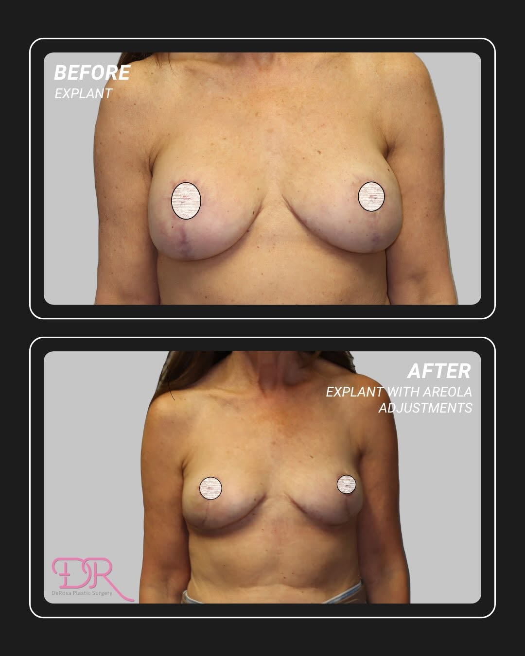 Instagram post by Dr. Amy DeRosa, DO: Breast implant removal with total, intact, capsulectomy perform performed by Dr. Amy DeRosa. After pictures were taken just six weeks postop…