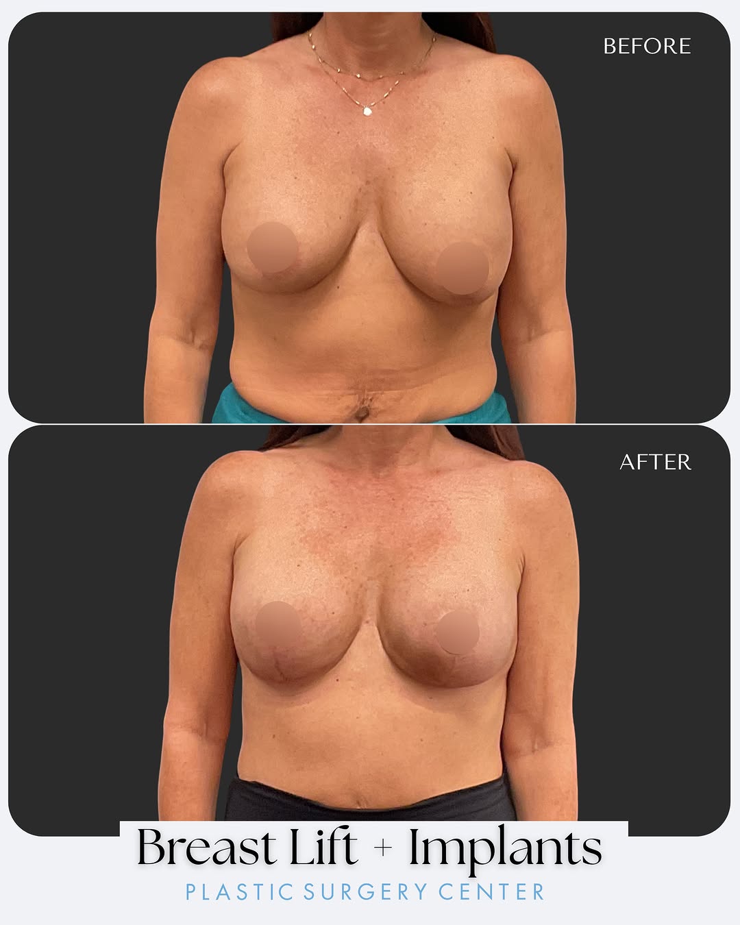 Instagram post by Dr. Amy M. Sprole: Time, gravity, and aging can change the appearance of your breasts, even after a previous augmentation. This 52-year-old patient had saline …