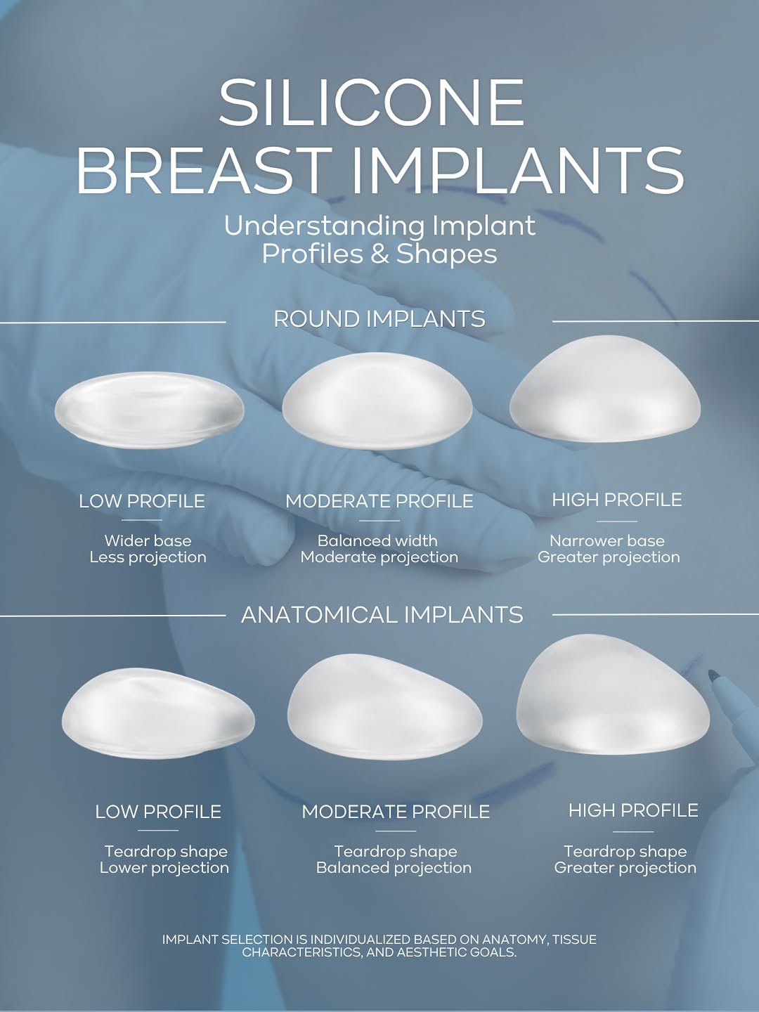 Instagram post by Dr. Andre Aboolian: Silicone breast implants are not one-size-fits-all. Profile and shape influence how an implant sits on the chest, its projection, and the ov…