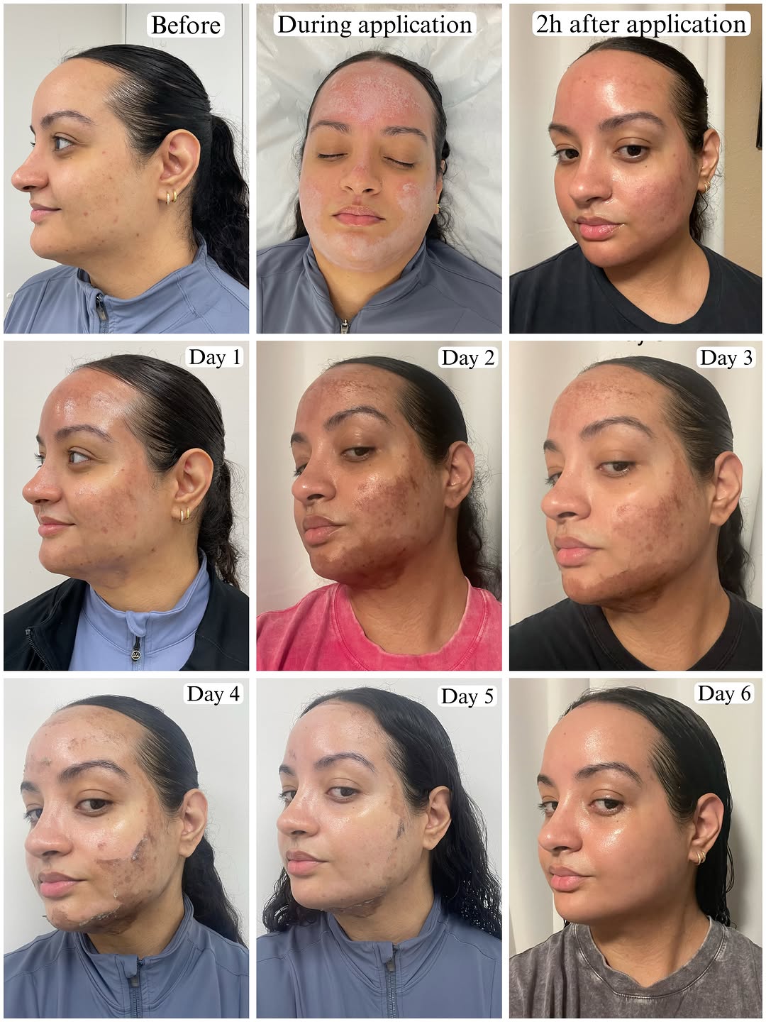 Instagram post by Dr. Andrea B. Trowers: ✨ Meet our NEW TCA 15% Peel ✨ Looking to elevate your skincare results? Benefits of the TCA 15% Peel: 🤍 Improved overall skin texture 🤍 Re…
