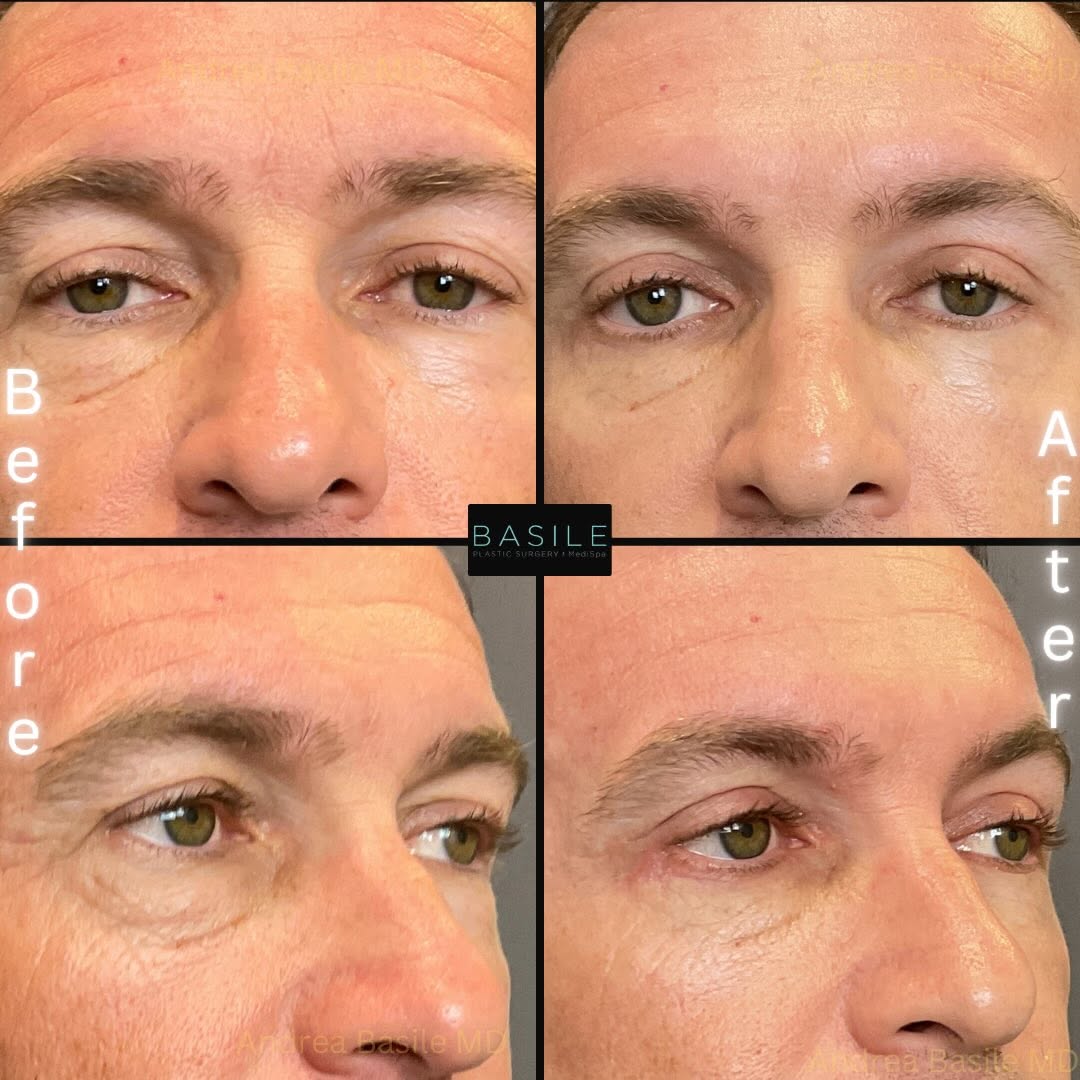 Instagram post by Dr. Andrea Basile: Looking tired even when you’re well-rested? Excess upper eyelid skin and under-eye bags can add years to your appearance and create a consta…