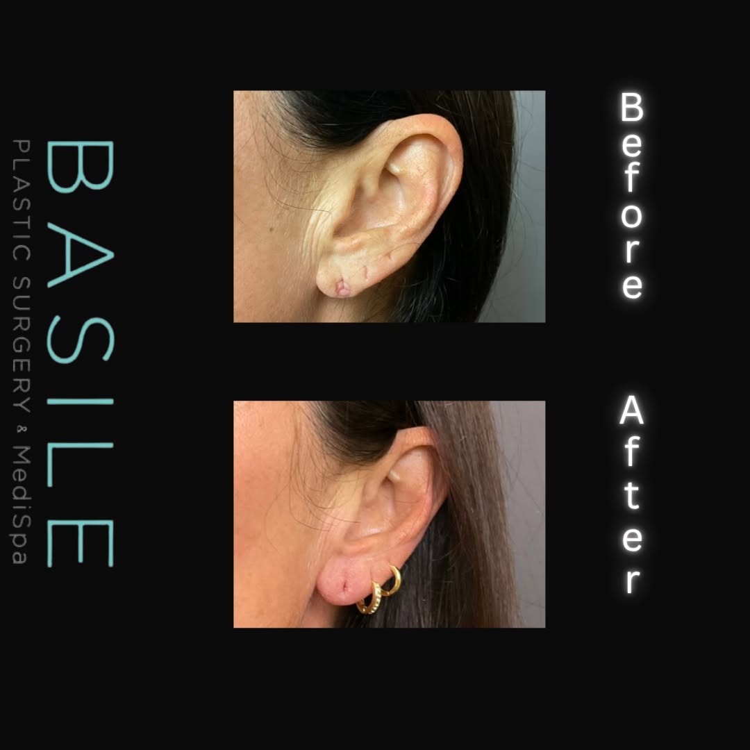 Instagram post by Dr. Andrea Basile: A little filler can make a beautiful difference. This before & after shows how restoring volume to the earlobes can create a smoother, more …