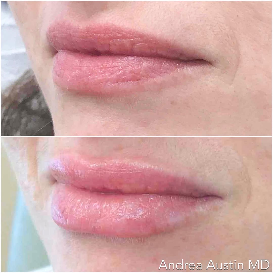 Instagram post by Dr. Andrea Hui Austin: A kiss off to a fabulous weekend! 💋 Specializing in always natural, never over done, Dr. Austin fulfilled this patient’s desire to have a b…