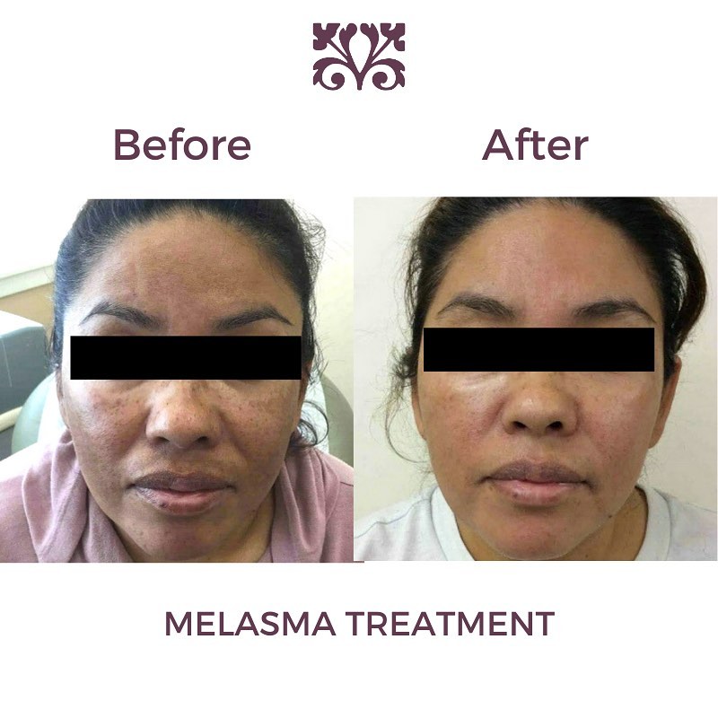 Instagram post by Dr. Andrea Hui Austin: One of Dr. Austin's favorite transformations this year! Many people come to see Dr. Austin specifically for melasma. Melasma can be fr…