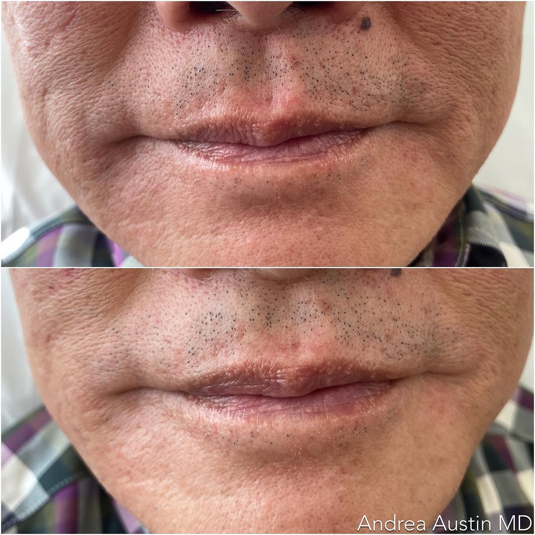 Instagram post by Dr. Andrea Hui Austin: Do men get cosmetic injectables? Absolutely! This lovely gentleman (age 70) decided that he wanted to smooth out his smile lines and finally…