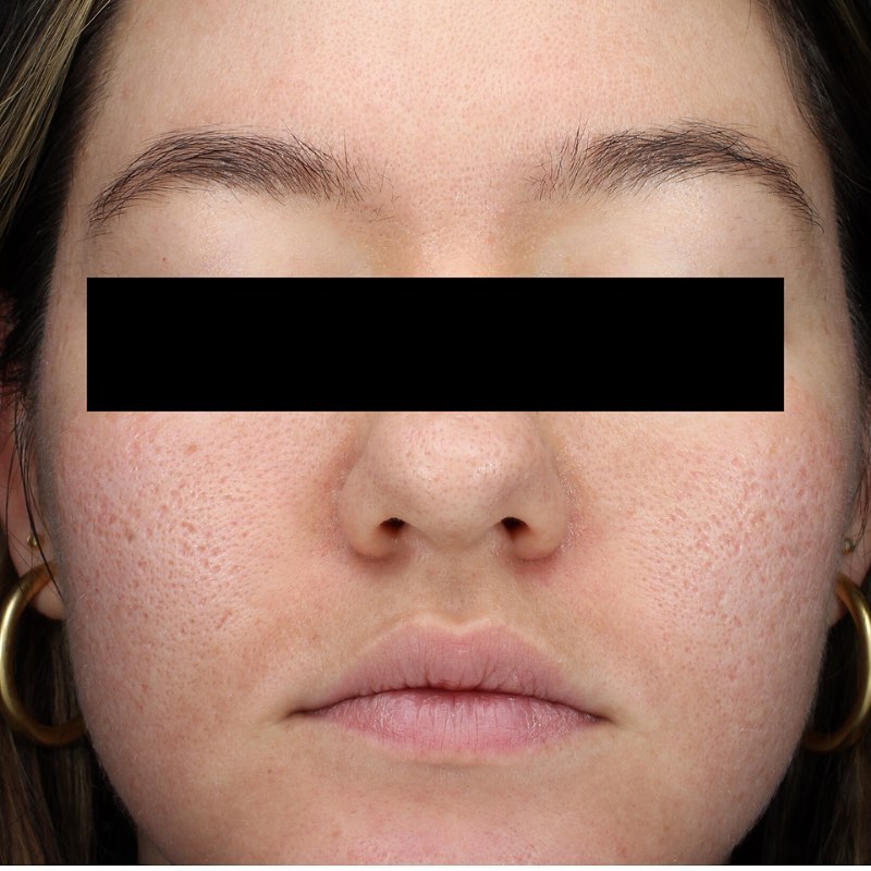 Instagram post by Dr. Andrea Hui Austin: This patient of mine came in hoping to reduce 'ice pick' scarring caused by past acne. This type of acne scarring is common and frust…