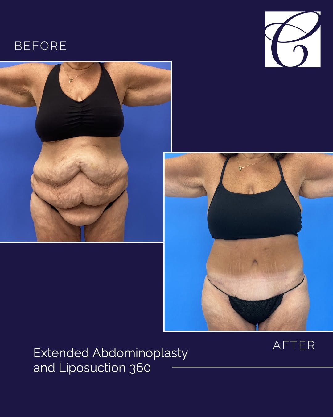 Instagram post by Dr. Andrea Martin: 56 years old and such a beautiful result with Dr. Martin. This patient had loose abdominal skin after losing 90 pounds. Dr. Martin addressed…