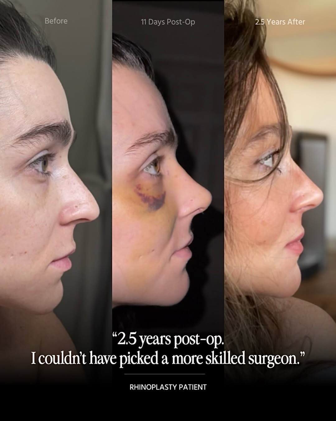 Instagram post by Dr. Andres Bustillo: Most people think the final result happens in a few weeks… Swipe to see why patience matters.👉🏻 #RhinoplastyRecovery #NosejobHealing #Rhin…