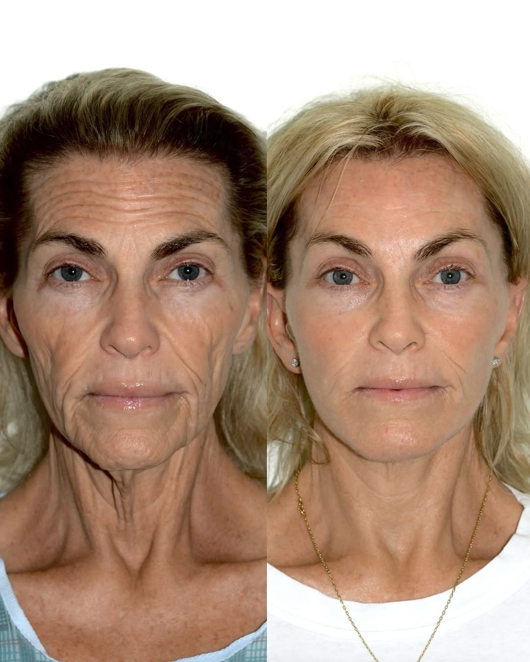 Instagram post by Dr. Andres Bustillo: I was honestly 🤯blown away by her results, actually we both were! Our beautiful patient is 🗓️4 months post-op✔️ She wanted a natural refre…