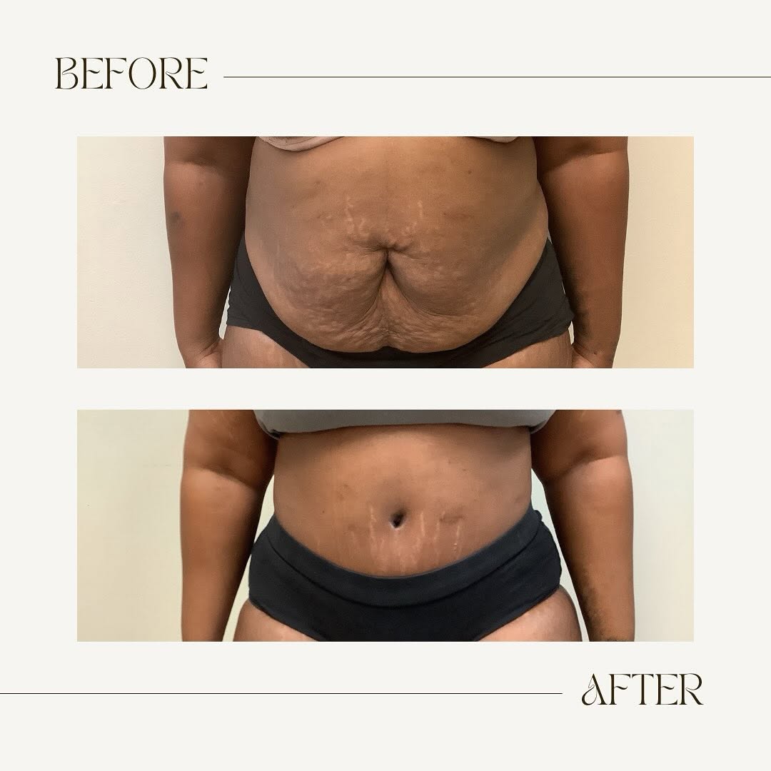 Instagram post by Dr. Andrew Freel: This 44 year old mother of two lost 50 pounds following a gastric bypass surgery before undergoing a tummy tuck with liposuction in order to…