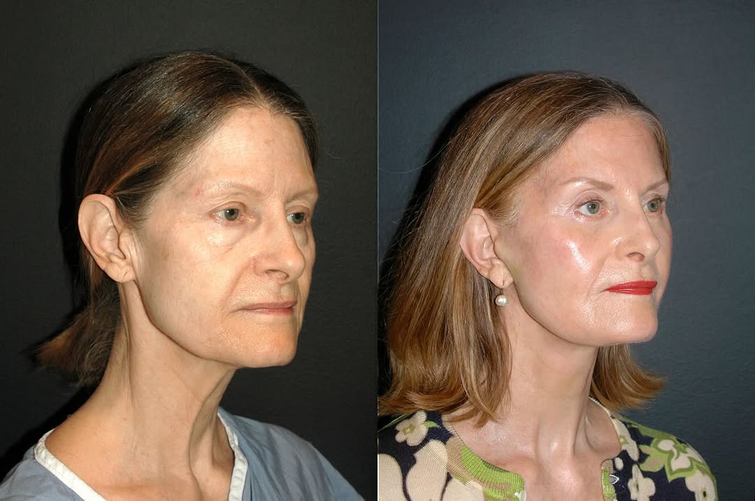Instagram post by Dr. Andrew Jacono: 6 weeks post-surgery and this 69 year old woman is already glowing ✨ This beautiful patient (yes, I know she has makeup on!) I had the privi…