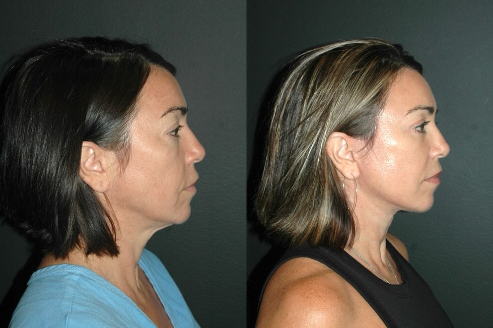 Instagram post by Dr. Andrew Jacono: Just saw my lovely patient for her 4-month follow-up ✨ She underwent a deep plane facelift, neck lift, upper and lower blepharoplasty, and a…