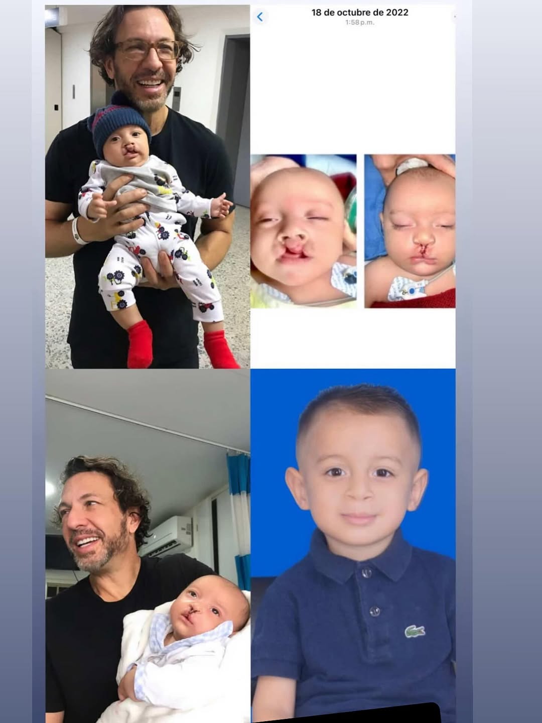 Instagram post by Dr. Andrew Jacono: Just got these pictures from his mom. 3 years after I performed his cleft lip surgery in South America. I am blessed to have been able to he…