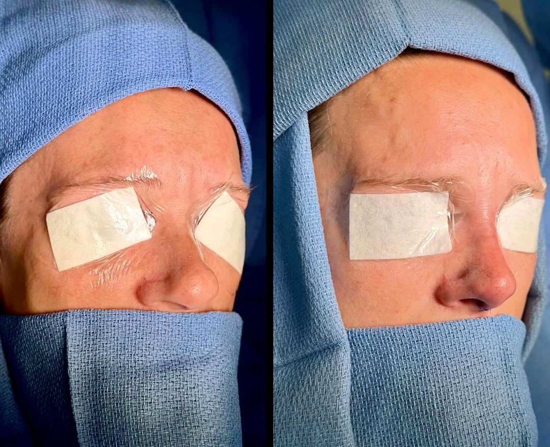 Instagram post by Dr. Andrew P. Ordon: 👃🏻Revision rhinoplasty! She had a closed rhinoplasty done many years ago, but didn’t like: 1️⃣ her bulbous tip, 2️⃣ the over-projection, 3…