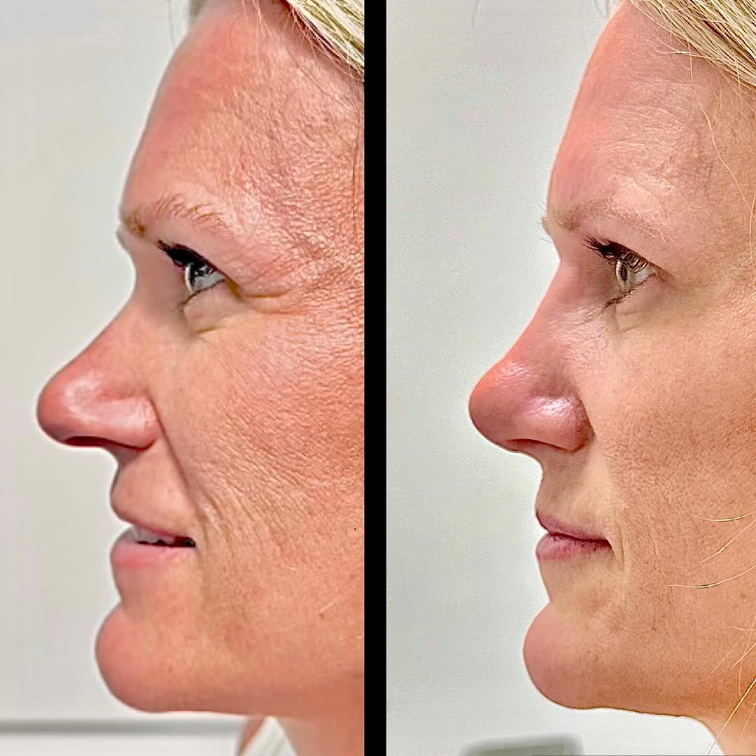 Instagram post by Dr. Andrew P. Ordon: 👃🏻Revision Rhinoplasty 6wk update - ✅ filled in her deep radix (brow/bridge transition), ✅ deprojected her nose, ✅ rotated her nose. Even …