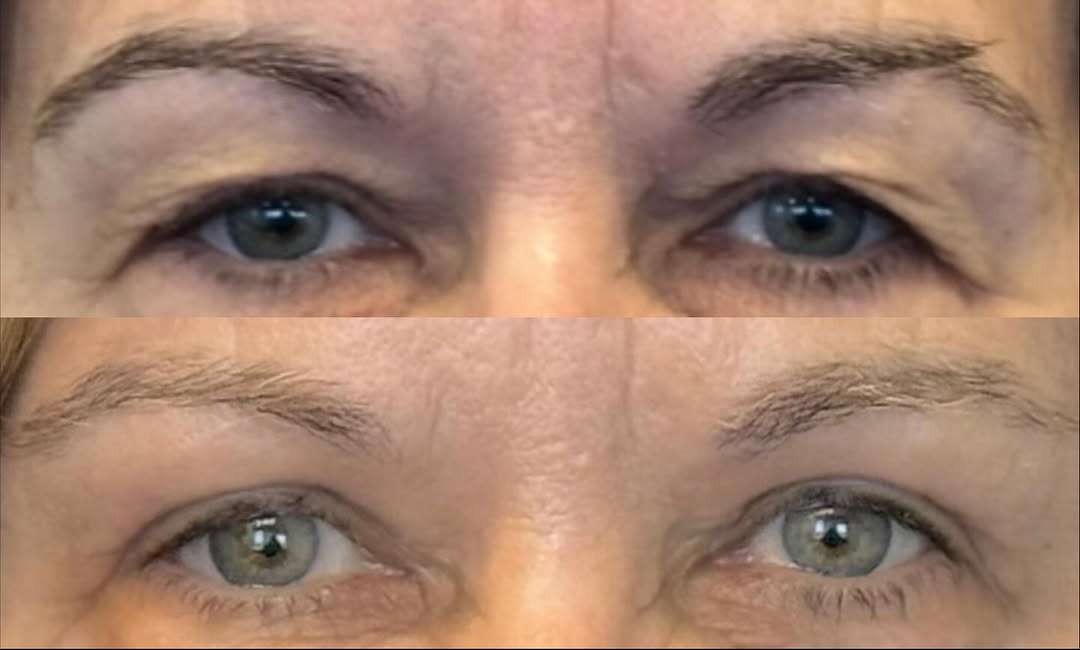 Instagram post by Dr. Andrew P. Ordon: Upper blepharoplasty (eyelid lift) is a procedure that involves meticulous skin tailoring and fat sculpting to rejuvenate and refresh the ap…