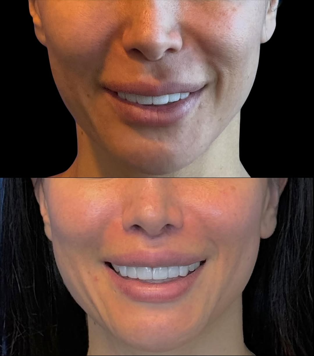 Instagram post by Dr. Andrew P. Ordon: Lip lift is a procedure that aims to shorten an upper lip that has elongated with time and aging. The goal is to improve the volume, shape, …