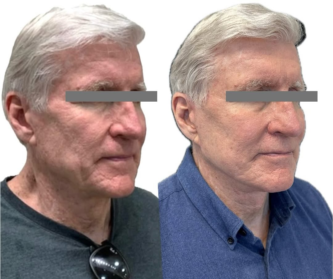 Instagram post by Dr. Andrew P. Ordon: ‼️Male facelift ≠ Female facelift‼️ This 66-year-old patient wanted to turn back the clock but still feel like himself. We achieved that via…