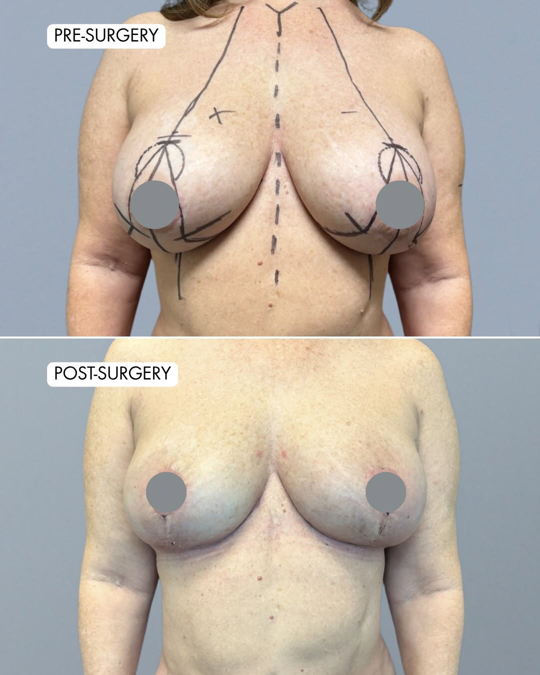 Instagram post by Dr. Andrew P. Ordon: The trifecta for natural breast rejuvenation: 1)Breast implant removal ✂️ 2)Breast lift ⬆️ 3)Fat grafting 🔑 This patient in her mid-50s gre…