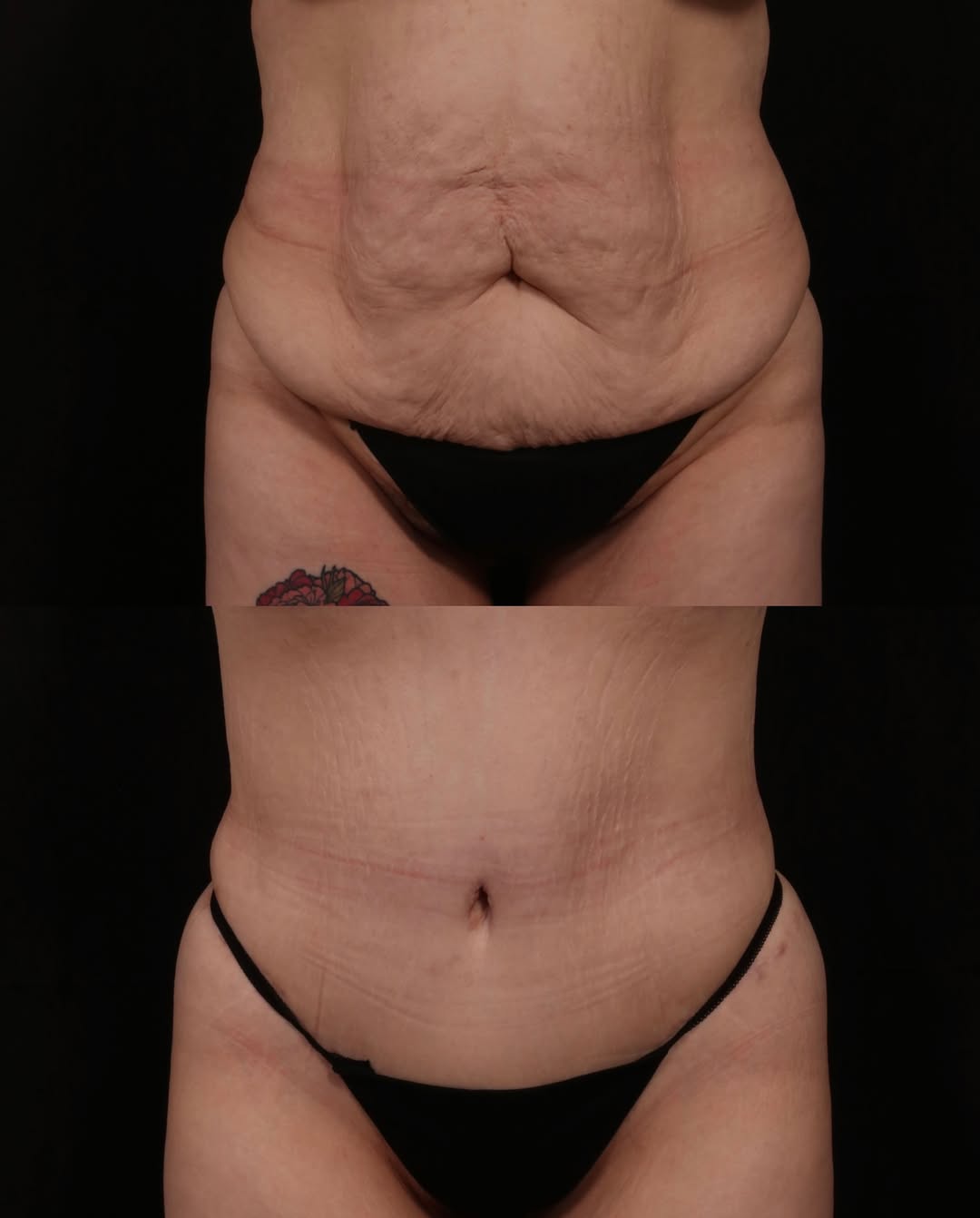 Instagram post by Dr. Andrew P. Trussler: Two years later, and the transformation speaks for itself. ✨ This patient is 2 years post-op from a full abdominoplasty with muscle repair a…