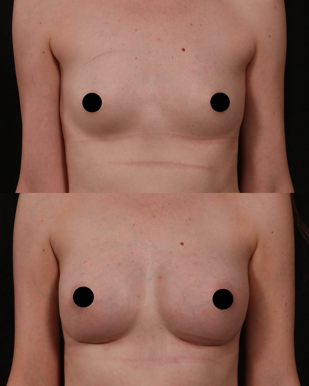 Instagram post by Dr. Andrew P. Trussler: Subtle volume. Soft shape. Natural proportion. ✨ This patient is 3 months post-op from a primary breast augmentation with Dr. Trussler using…