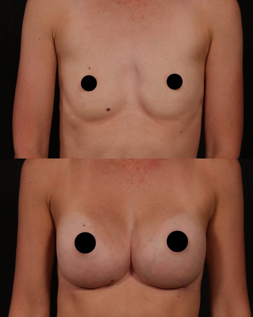 Instagram post by Dr. Andrew P. Trussler: A little structure can make all the difference. ✨ Breast augmentation isn’t always just about adding volume. For this patient, the goal was …