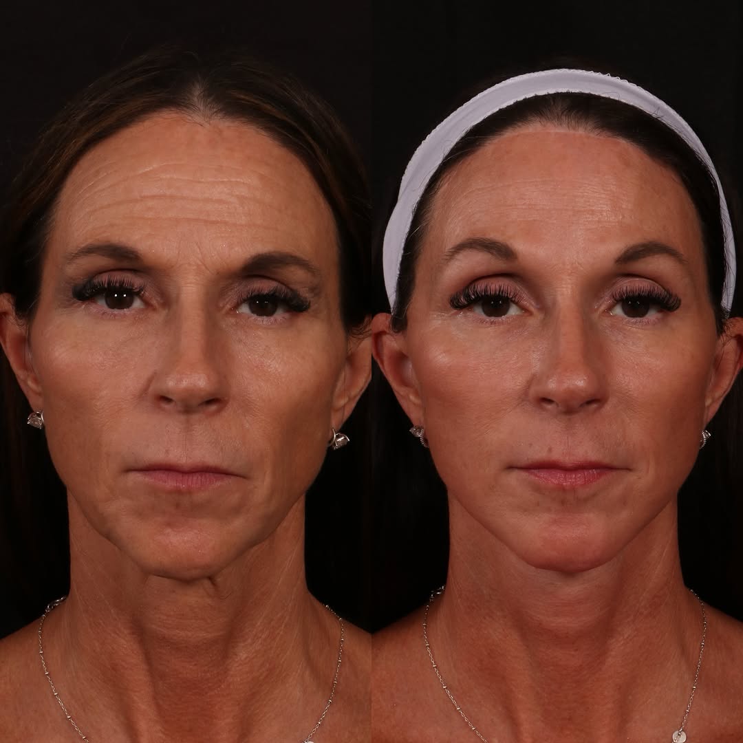 Instagram post by Dr. Andrew P. Trussler: A year later, and the result speaks for itself. ✨ Facial rejuvenation isn’t about creating a different face—it’s about restoring the structu…