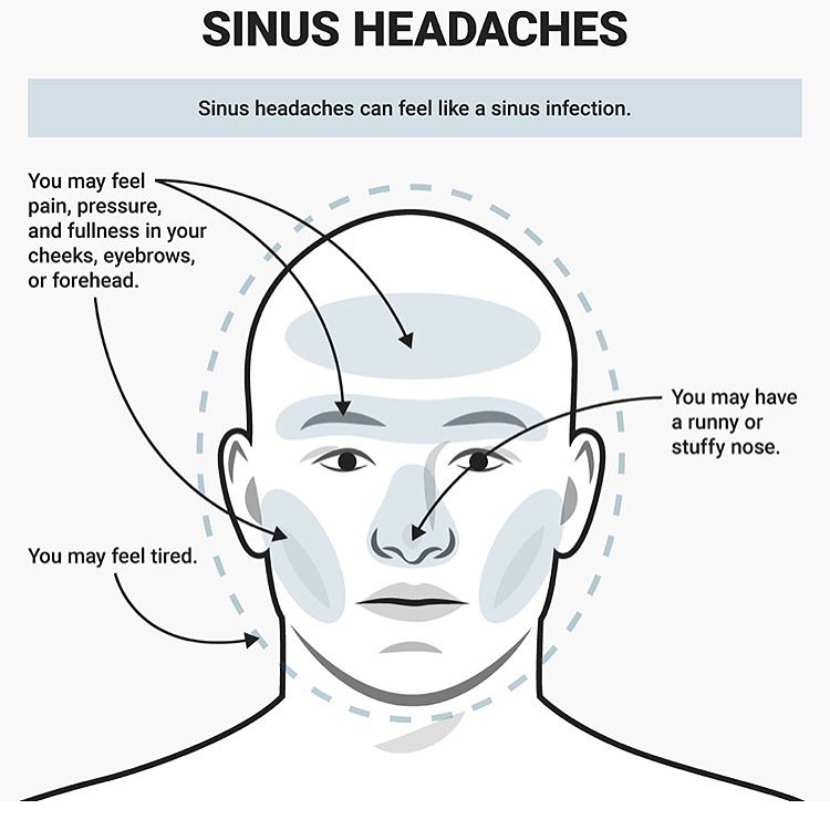 Instagram post by Dr. Andrew S. Florea: 🤕Not all headaches hurt the same🌡 ➡️Swipe through to know which type you may be experiencing. ❗️If this is a chronic condition, come see u…