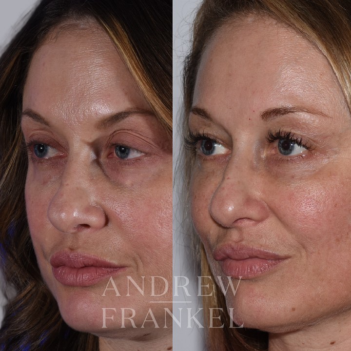Instagram post by Dr. Andrew S. Frankel: Patients often focus on loose or excessive skin covering their upper eyelids and request tissue removal to make more of the eyelid visible, …