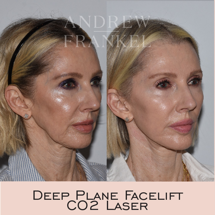 Instagram post by Dr. Andrew S. Frankel: Twenty-one months following Deep Plane Face Lift with Fractional CO2 resurfacing. Thin patients with inelastic skin pose challenges that are…