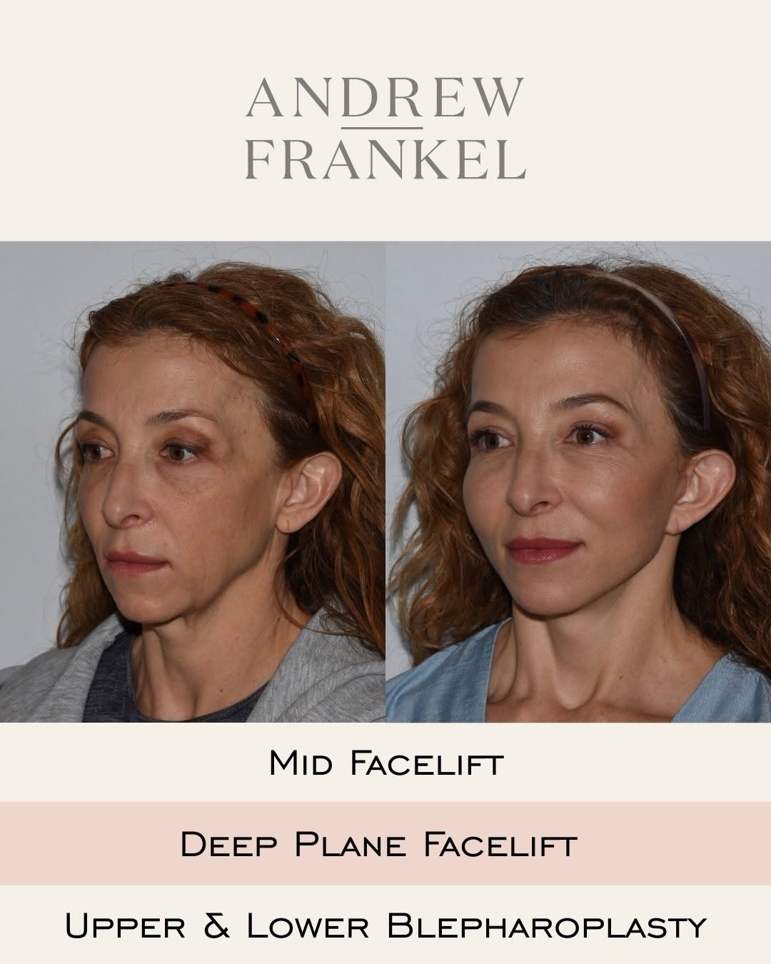 Instagram post by Dr. Andrew S. Frankel: I’ve been performing, writing about, and lecturing on midface lifts for over 20 years. I consider midface lifts to be distinctly different f…