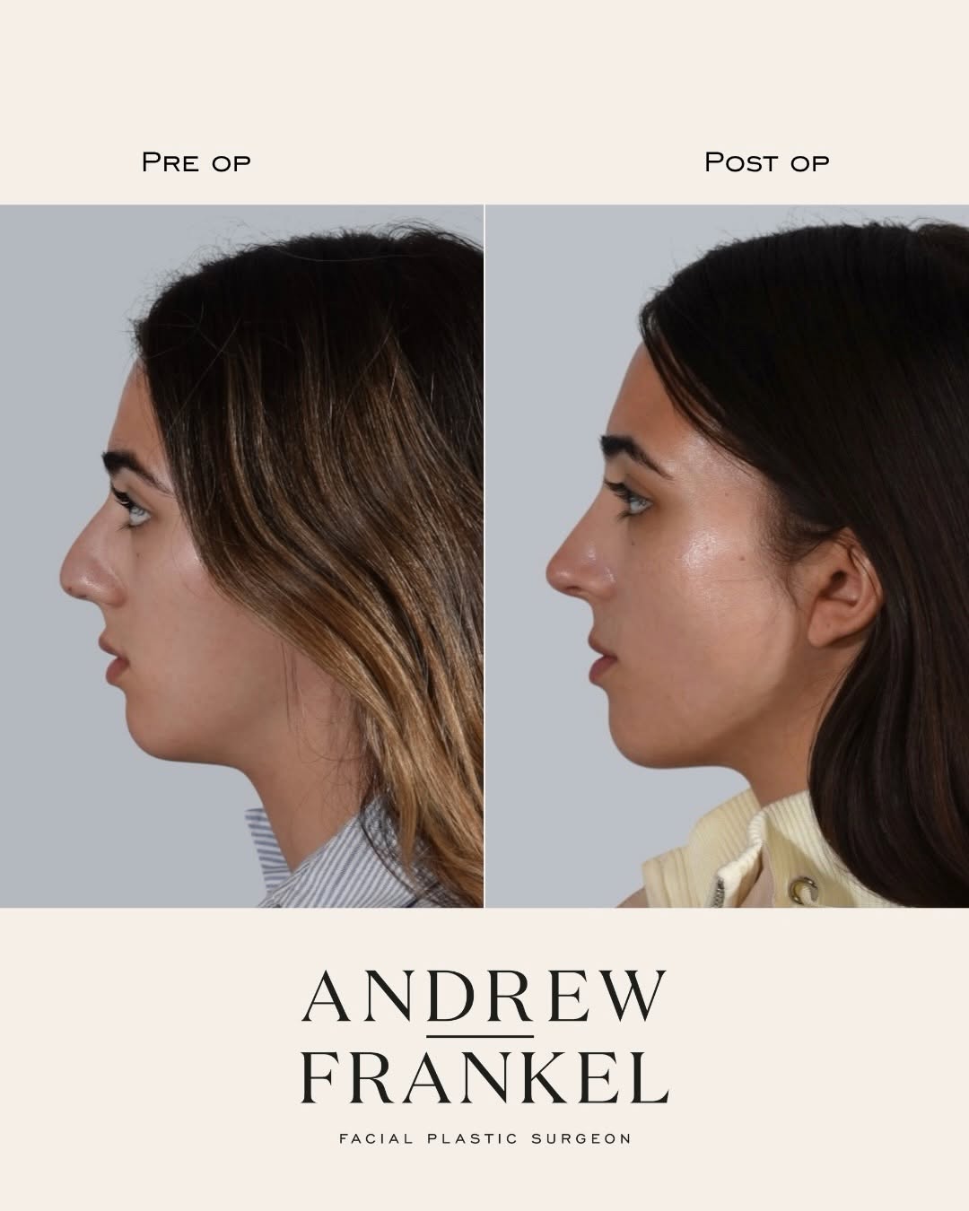 Instagram post by Dr. Andrew S. Frankel: This young woman wanted a different shape to her nose while maintaining a result that looked natural and balanced with her features. In addi…
