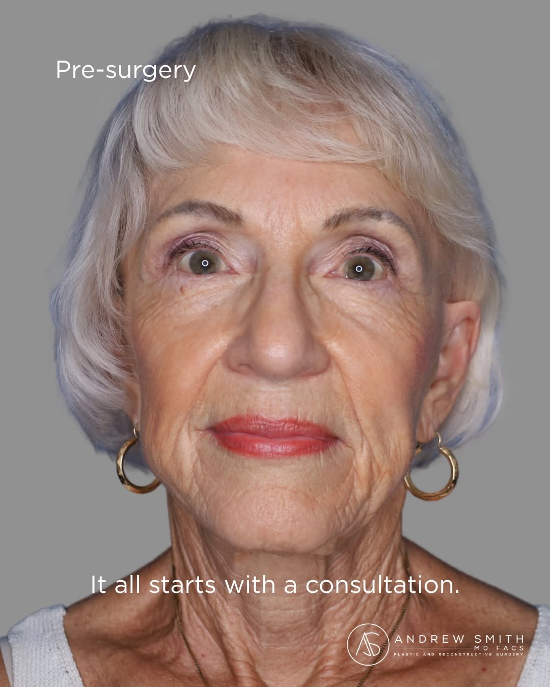 Instagram post by Dr. Andrew Smith: Confidence looks different on everyone—and this patient’s transformation is a beautiful example of what can happen with a personalized surgi…