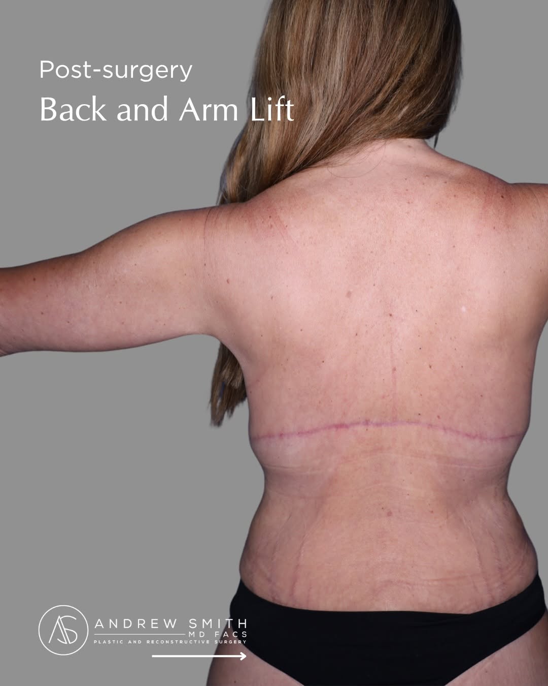 Instagram post by Dr. Andrew Smith: A refined approach to contouring the upper body. This patient underwent an arm lift and back lift to address excess skin and create a smooth…