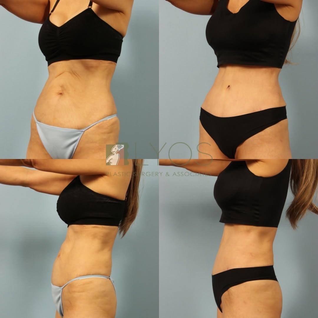 Instagram post by Dr. Andrew T. Lyos: An amazing 7 month Tummy Tuck and hernia repair result performed by Dr. Lyos✨ Interested in this procedure? Call our office to schedule a co…