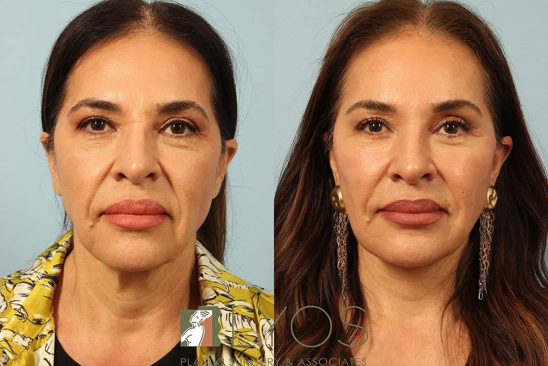 Instagram post by Dr. Andrew T. Lyos: When surgery meets artistry, magic happens! This isn’t just a Face and Necklift this is ART ✨ Interested in this procedure? Call our office …