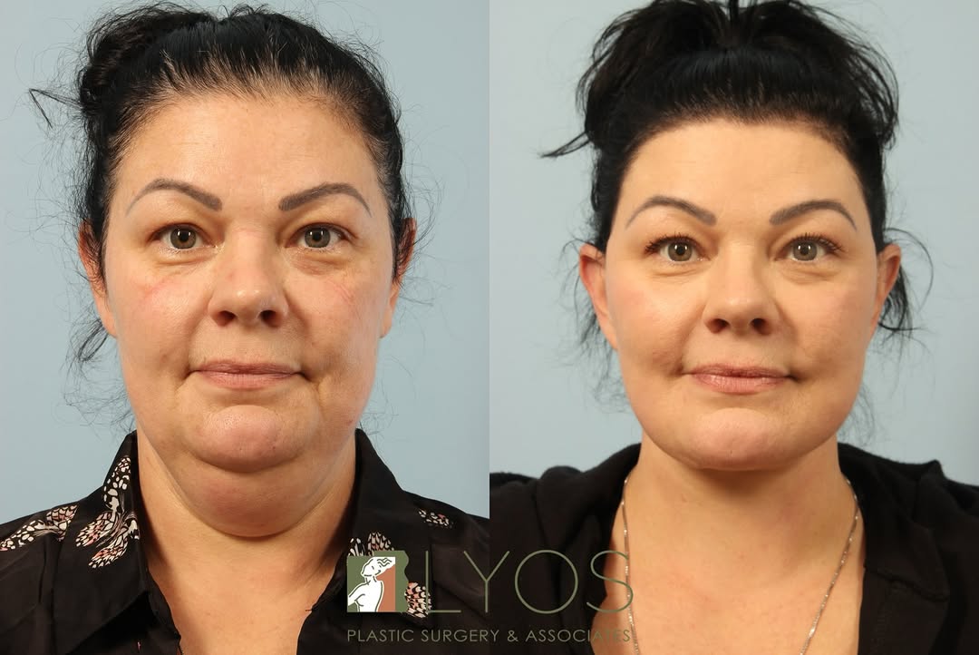 Instagram post by Dr. Andrew T. Lyos: Check out these amazing SMAS Lift results ✨ Patient Testimonial: This surgeon sure has a “gifted and dedicated approach, he exceeded my expe…
