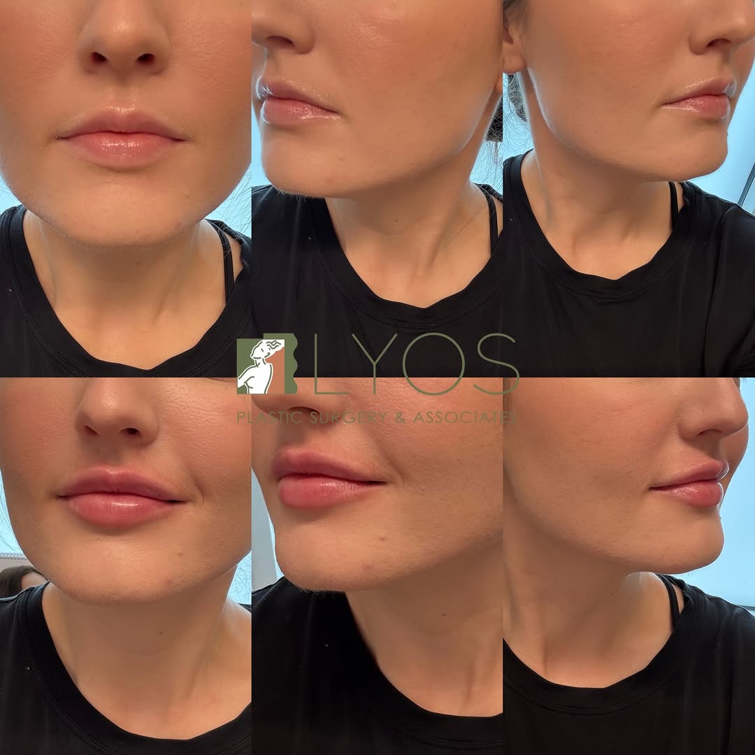 Instagram post by Dr. Andrew T. Lyos: Precision, artistry, and a soft bridal finish 💍✨💉👄 Lips by Dr. Lyos #bridalseries #lipfiller #confidence #plasticsurgery #medspa #houston…