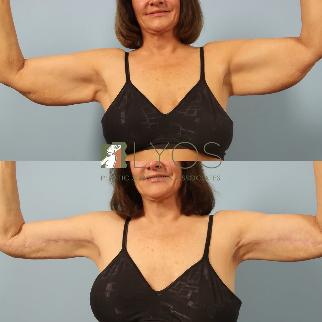 Instagram post by Dr. Andrew T. Lyos: Sculpting confidence from every angle ✨ A brachioplasty (arm lift) removes excess skin and reshapes the upper arms to create a more defined,…