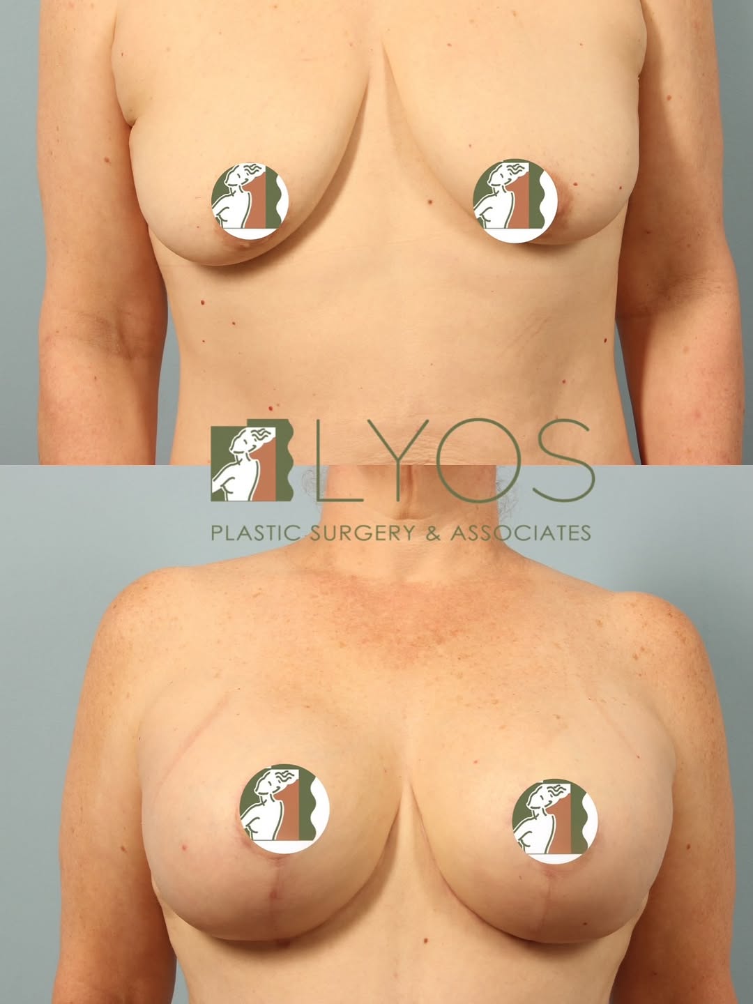 Instagram post by Dr. Andrew T. Lyos: Lifted, enhanced, and beautifully balanced ✨ Breast augmentation with a full mastopexy for the ultimate transformation. 💕 Interested in a c…