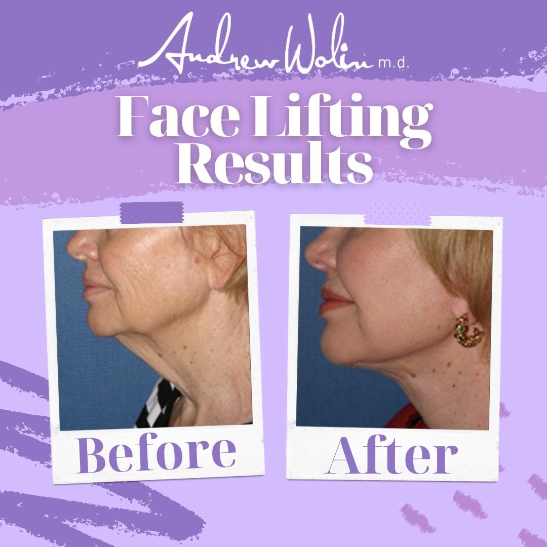 Instagram post by Dr. Andrew Wolin: Check out these amazing results! Face Lifting helps tighten skin and reduces wrinkles. Every patient at the Wolin Plastic Surgery Center rec…