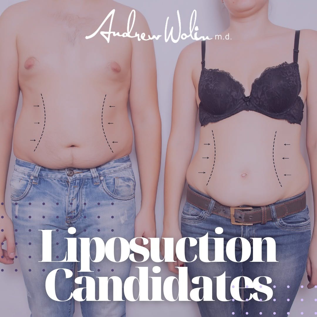 Instagram post by Dr. Andrew Wolin: Those who are in good health and have a steady weight are good candidates for liposuction. You may be an excellent candidate for liposuction…
