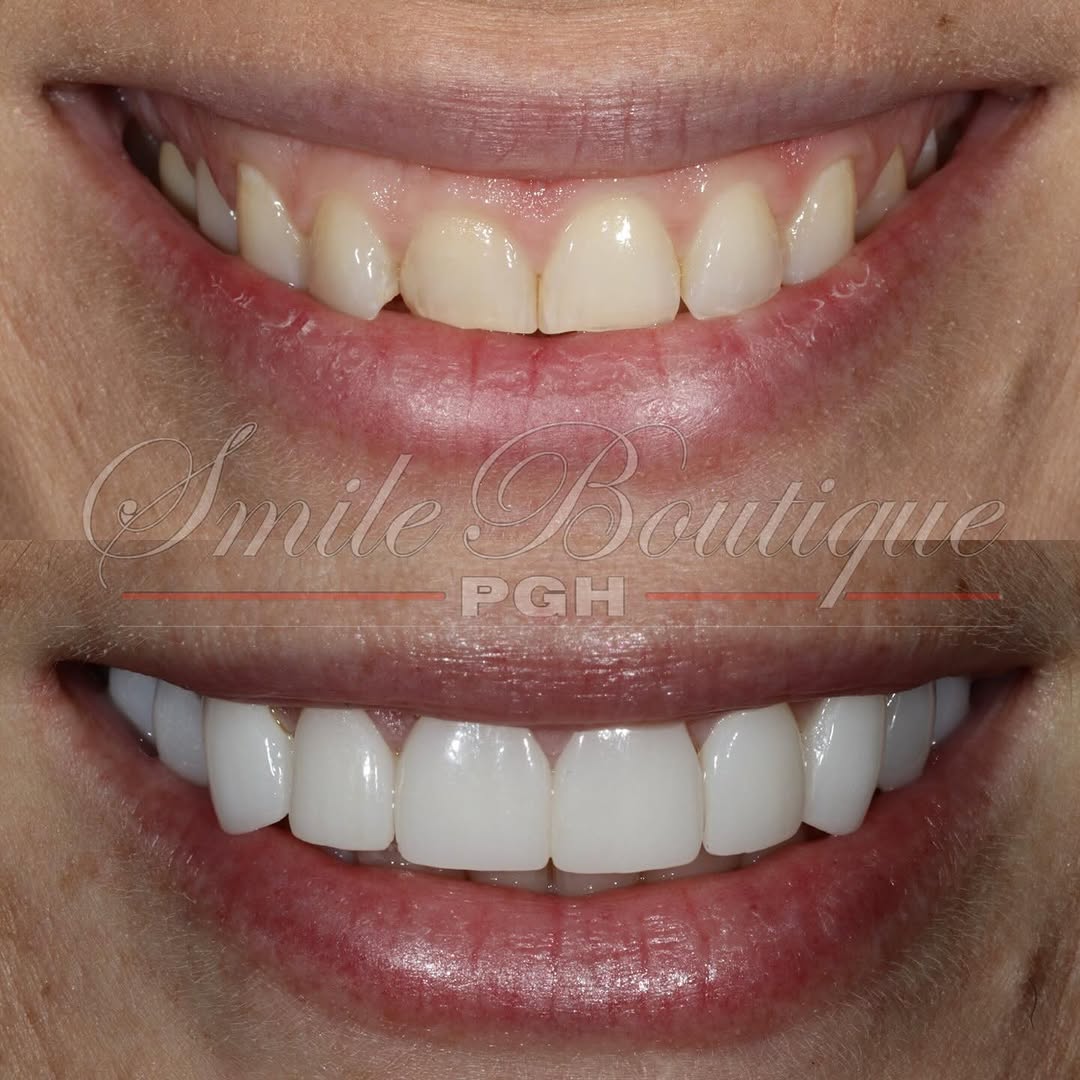 Instagram post by Dr. Andy Shieh, D: Monday Motivation 🤩 Featuring Dr. @k.ziggas’ smile transformation 🙌 Her dislikes (✖️) & what we achieved (✔️): ✖️ Small teeth (don’t show …