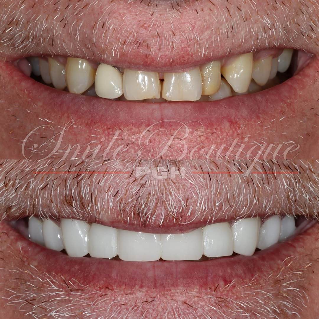 Instagram post by Dr. Andy Shieh, D: Friday Smile Feature 💫 Had the wonderful privilege to meet & work with Dr. Ray, who was never happy about his smile, in his smile transform…