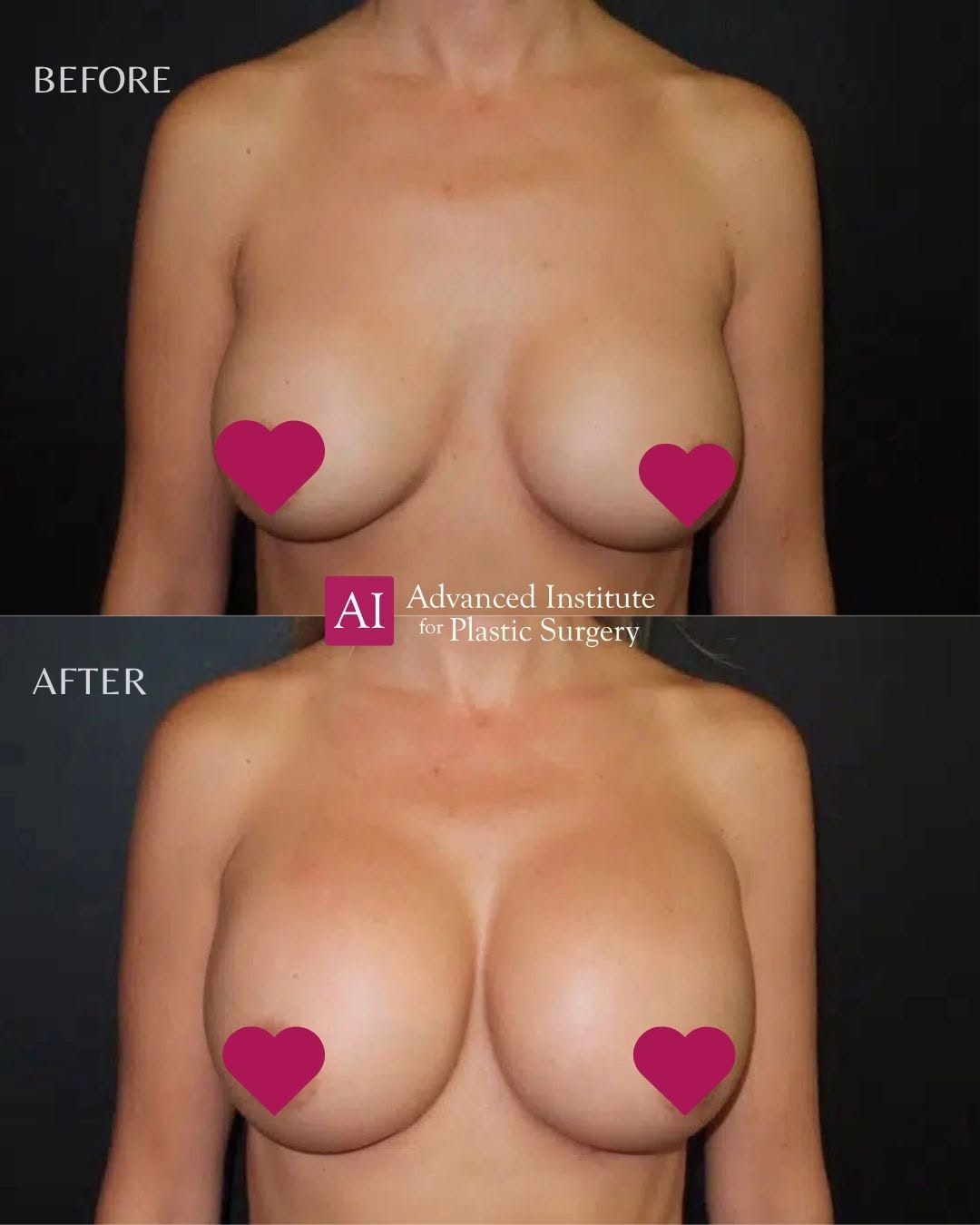 Instagram post by Dr. Andy Wongworawat: Breast revision is rarely one-size-fits-all. Some corrections are simple and done in the office under local anesthesia. Others require the o…