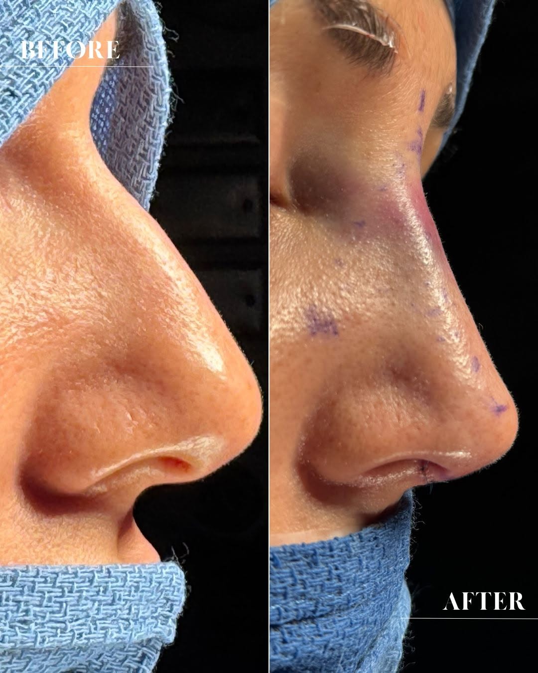 Instagram post by Dr. Angela Sturm: It’s not just about a smaller nose—it’s about the right nose for you. 👃 This beautiful transformation shows what’s possible when we focus o…
