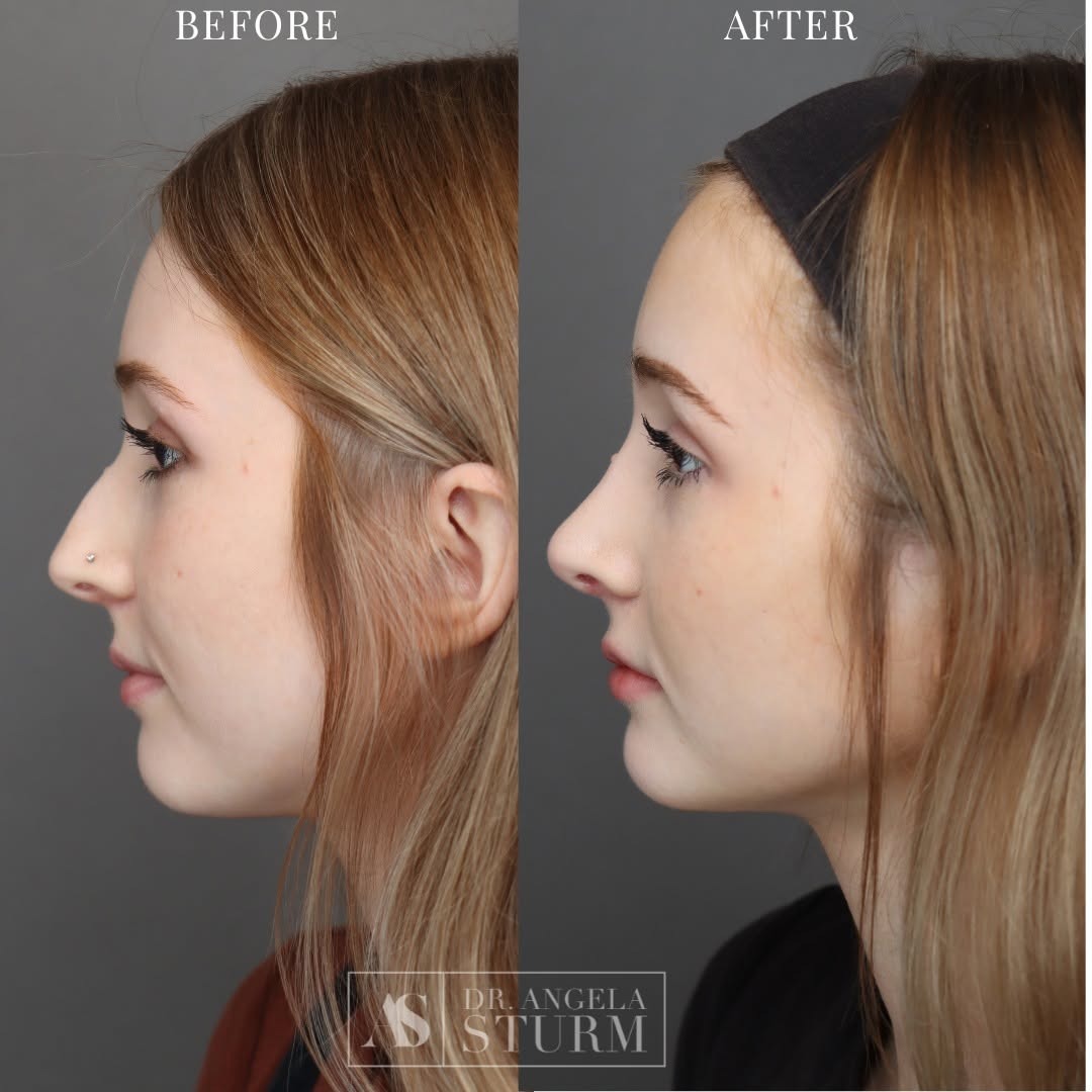 rhinoplasty, rhinoplasty before and after, rhinoplasty surgeon, revision rhinoplasty, rhinoplasty expert, nose job, nose job houston, houston rhinoplasty, houston nose job, houston plastic surgeon